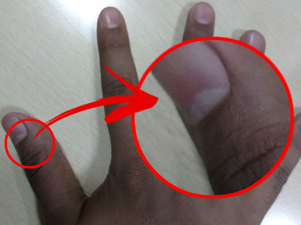 விரல் நக பிறையின் நிற மாற்றம்