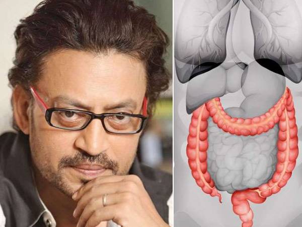 பெருங்குடல் தொற்று என்றால் என்ன? பெருங்குடல் தொற்று என்றால் என்ன?