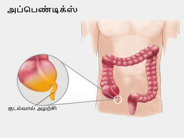 குடல்வால் அழற்சி/குடல் அழற்சி