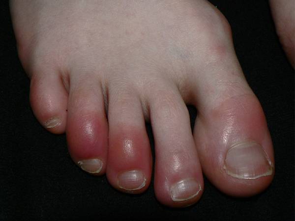 கடுங்குளிரால் ஏற்படும் கை கால் கொப்புளங்கள் (Chilblains)