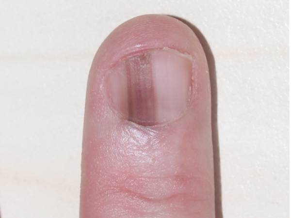 கோவிட் நகங்களின் அறிகுறிகள் எப்படி இருக்கும்?