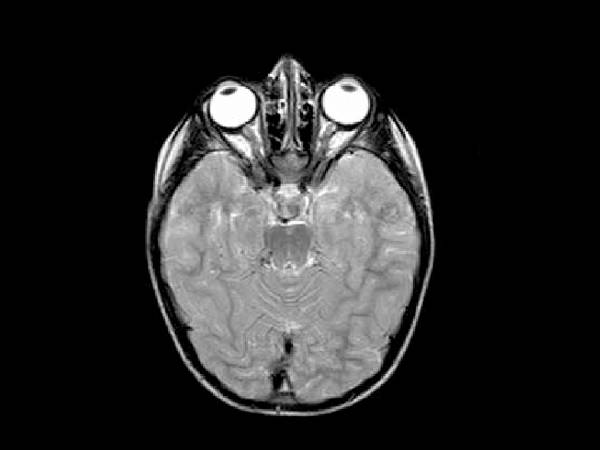 3. எம்ஆா்ஐ ஸ்கேன்
