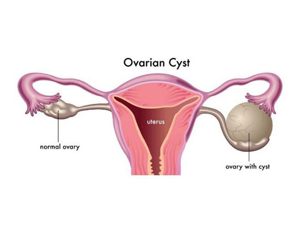 கருப்பை நீர்க்கட்டி