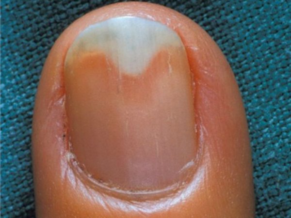 நகங்களில் ஓட்டை அல்லது குழிகள்