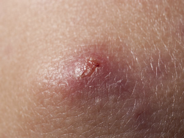 3. ஸ்டாஃப் தொற்றுகளை (Staph Infections) எதிா்த்து போாிடுகிறது