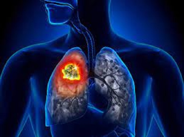 நுரையீரல் புற்றுநோய்