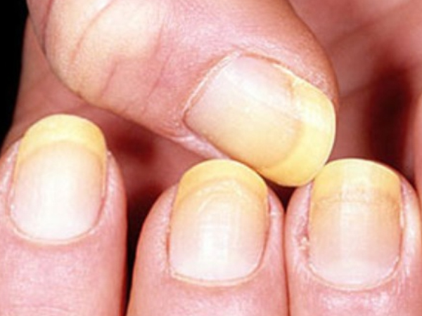 நகங்களில் மாற்றம்