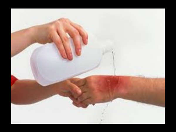  திறந்த காயத்திற்கு சிகிச்சையளிப்பதற்கான வழிகள் 