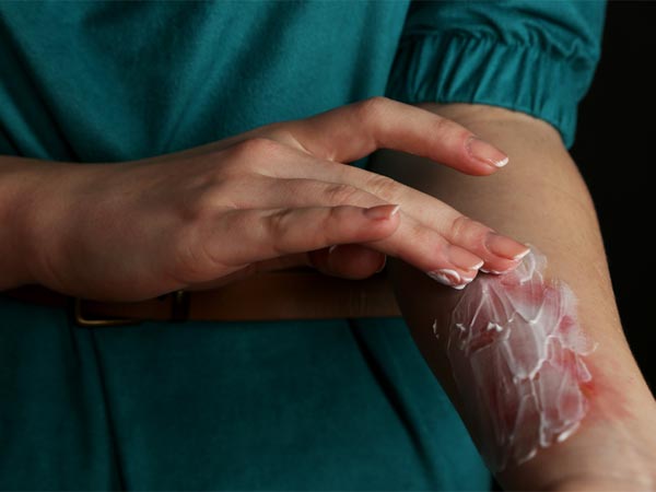 தீக்காயங்களுக்கு சிகிச்சையளிப்பது எப்படி