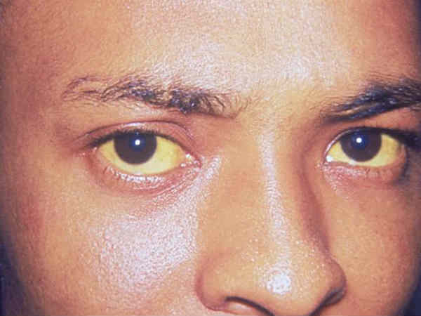 மஞ்சள் காய்ச்சல் (Yellow Fever)