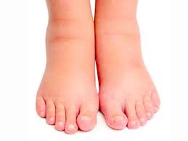 வீங்கிய கைகள் மற்றும் கால்கள்