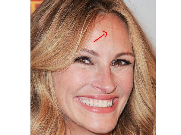 நெற்றியில் நரம்புகள் தெரிவது