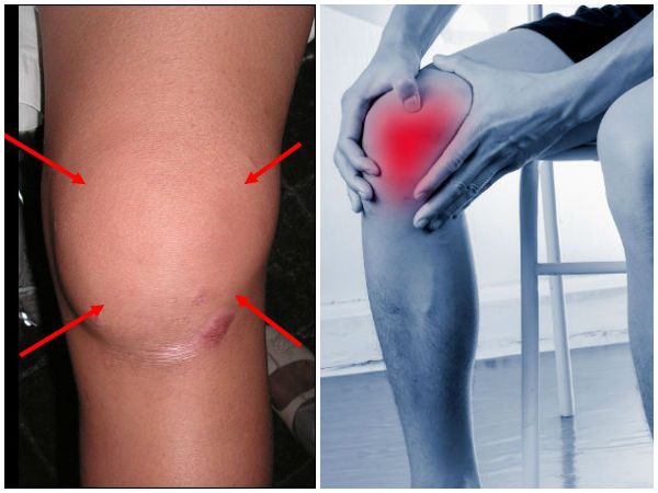 2. உடல் பருமன் மற்றும் கீல்வாதம் (Osteoarthritis) 2. உடல் பருமன் மற்றும் கீல்வாதம் (Osteoarthritis)