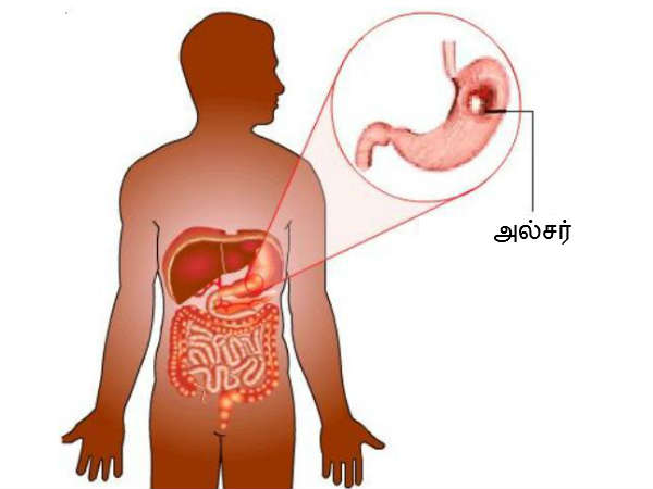 Eating These Foods Can Be Fatal For Ulcer Patient Eating These Foods Can Be Fatal For Ulcer Patient