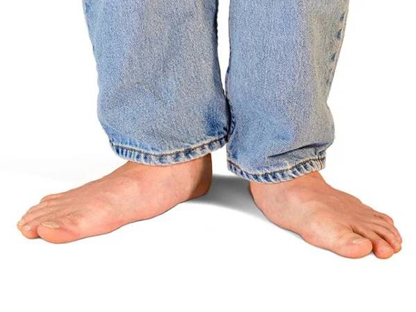 தட்டையான பாதங்கள் உருவாக காரணங்கள்