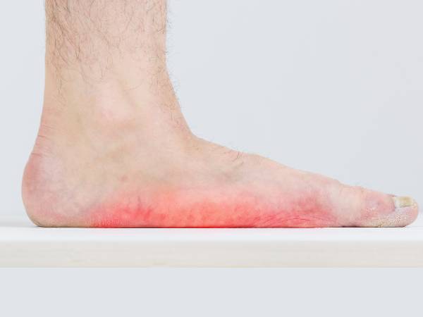 தட்டையான பாதங்களின் அறிகுறிகள்