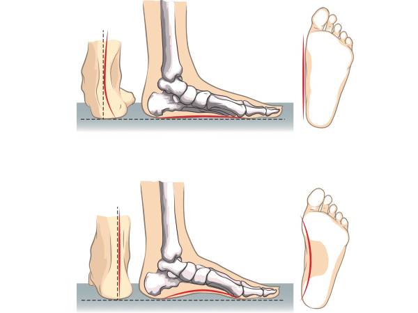 தட்டையான பாதங்களின் வகைகள்