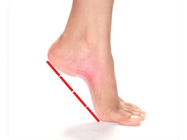 தட்டையான பாதங்களை எவ்வாறு பாிசோதனை செய்வது?