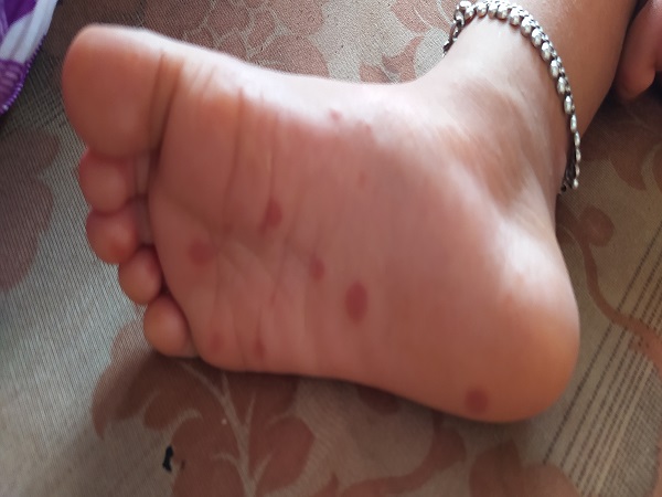 தக்காளி காய்ச்சலுக்கான காரணங்கள்