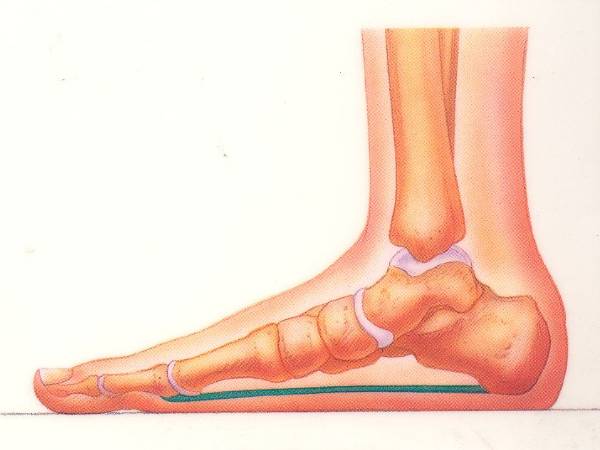 தட்டையான பாதங்களுக்கு உாிய மருத்துவ சிகிச்சைகள்: