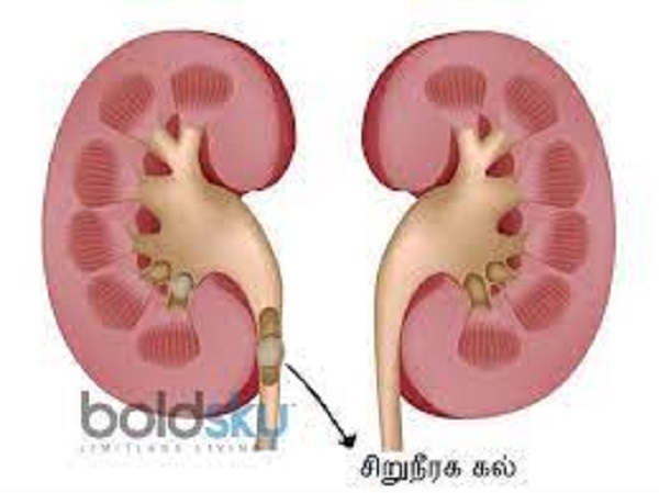 சிறுநீரகக் கற்கள் உருவாகும் வாய்ப்பை அதிகரிக்கும்
