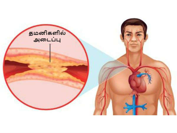 தமனிகளின் பிடிப்பு