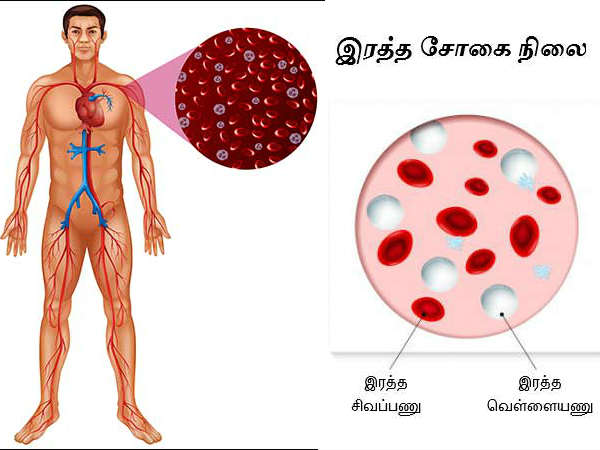 இரத்த சோகையை சரி செய்யலாம்