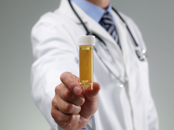 அடர் நிற சிறுநீர்