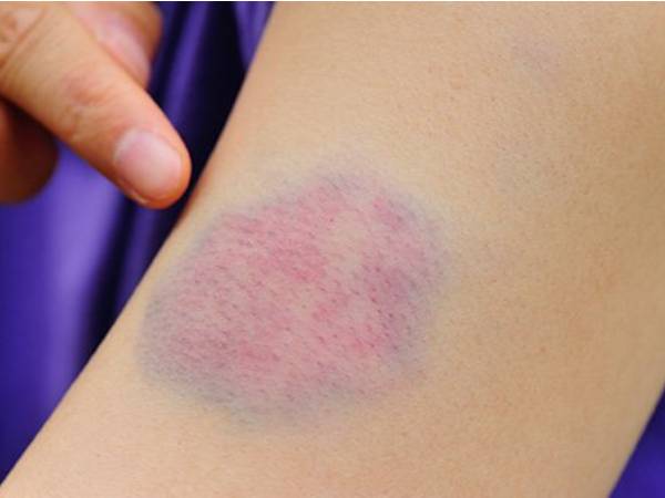 சிராய்ப்பு