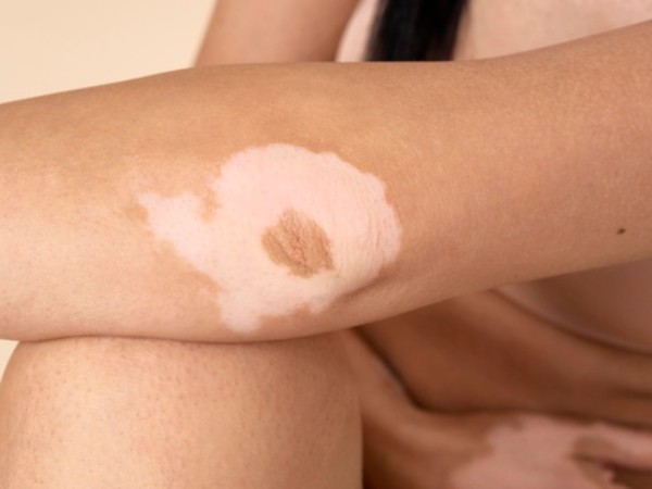 வெண்படை என்றால் என்ன?