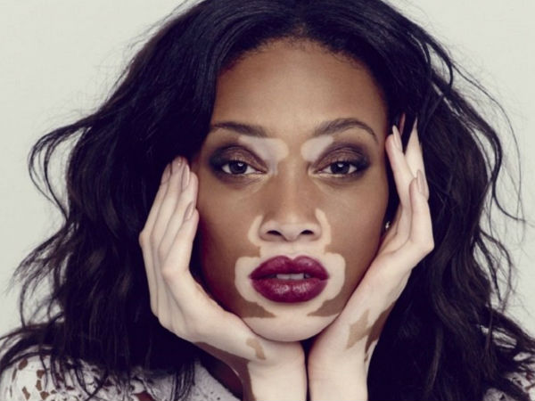  வெண்படை ஒரு தொற்றுநோயா?