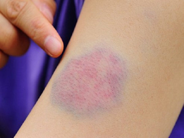 குழந்தைகளின் தீக்காயங்களை குணப்படுத்துகிறது