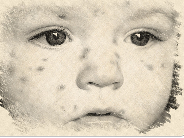 ரூபெல்லாவின் அறிகுறிகள்