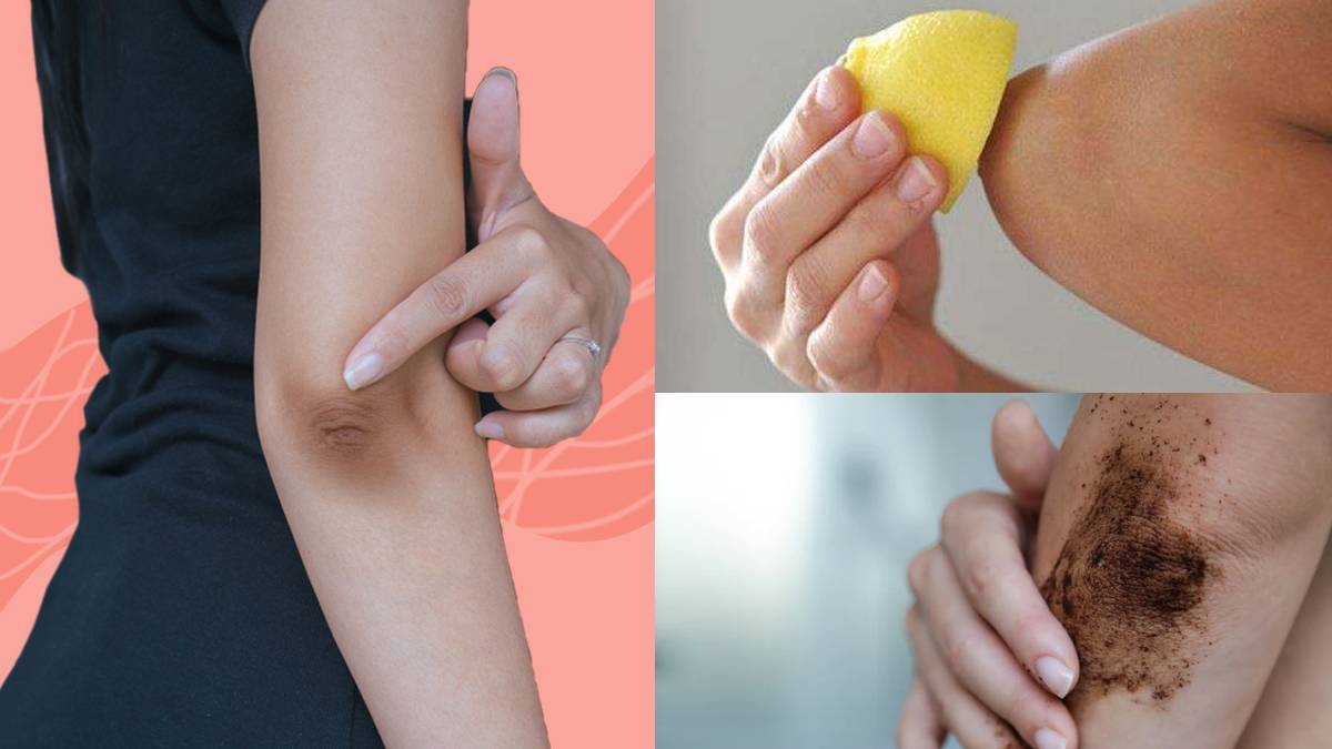 Ayurvedic Remedies For Dark Elbow In Tamil Ayurvedic Remedies For Dark Elbow In Tamil