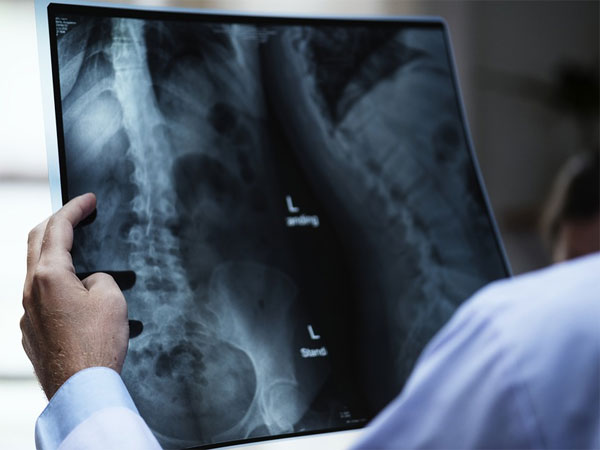 Langerhans Cell Histiocytosis: A Cancer Like Disease Occurs in Children in Tamil