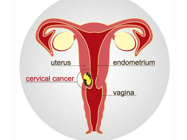 பிஏபி ஸ்மியர் சோதனை (PAP Smear Test) பிஏபி ஸ்மியர் சோதனை (PAP Smear Test)