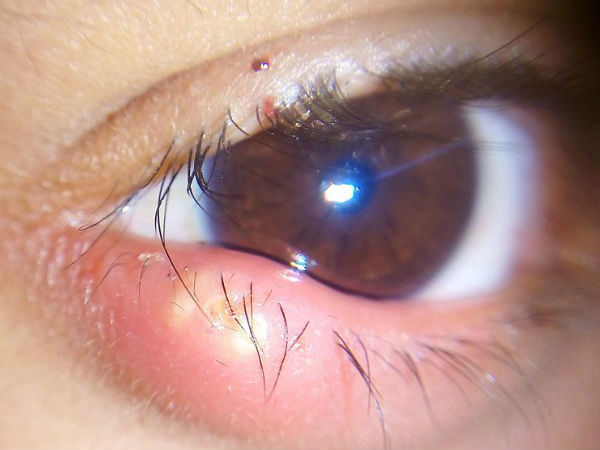Causes And Risk Factors Of Stye In Tamil