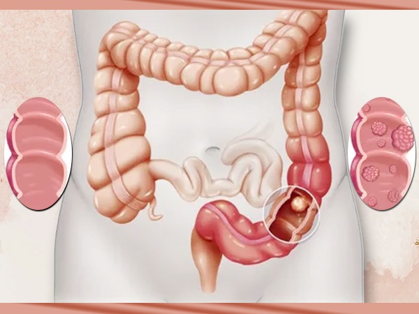 மலச்சிக்கல்