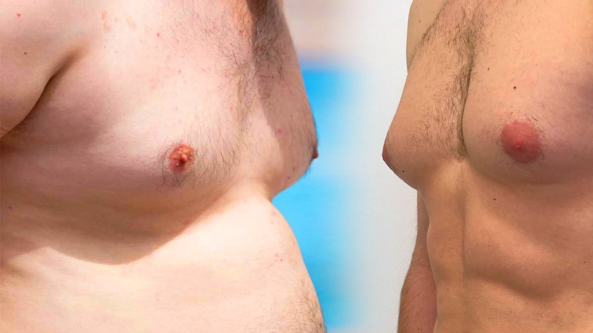 What Causes Enlarged Breasts in Men in Tamil What Causes Enlarged Breasts in Men in Tamil