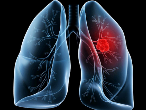 Lung Cancer: Strange Signs of Lung Cancer in Tamil