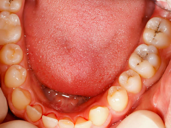 Oral cancer: Specific areas in your mouth where cancer can begin in tamil