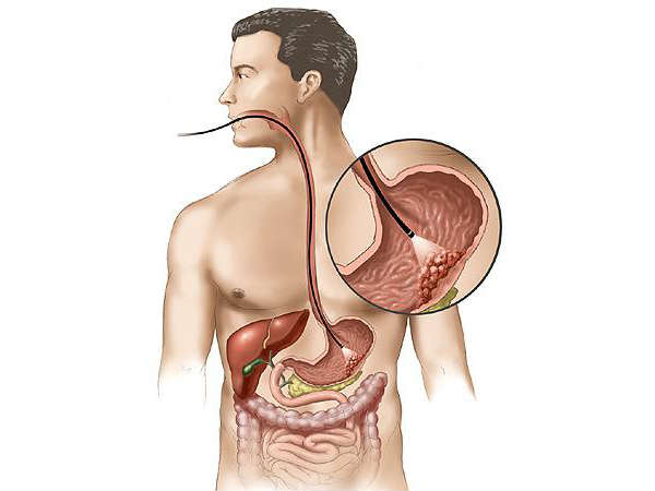 Throat symptoms of Esophageal cancer in tamil