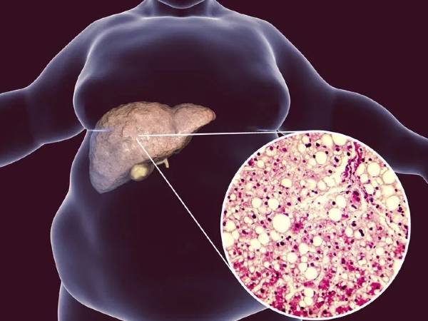 Ayurvedic Tea Can Fix Fatty Liver Naturally​ In Tamil