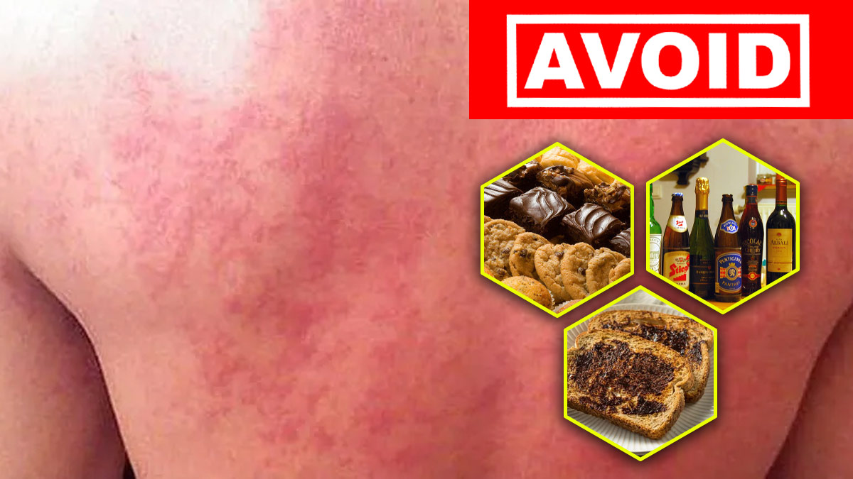 ஈஸ்ட் அலா்ஜி என்றால் என்ன? அதன் அறிகுறிகள் என்ன? எந்த உணவுகளை சாப்பிடக்கூடாது? Yeast Allergy