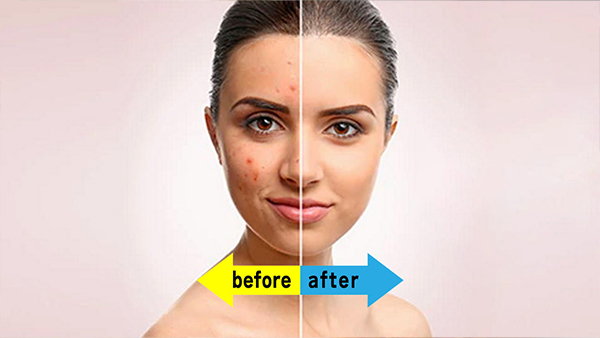 Skin Care Tips: Natural Face Packs To Remove Dark Spots In Tamil
