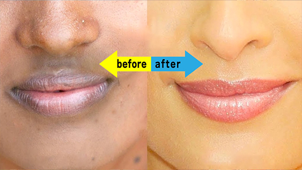 Skin Care Tips: Natural Ways To Remove Dark Skin Around Mouth In Tamil