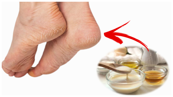 Skin Care Tips: Top Five Kitchen Remedies For Cracked Heels In Tamil