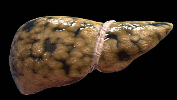 Fatty Liver in Children: Signs, Causes, and Prevention in Tamil