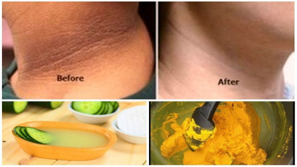 How To Get Rid Of Blackening Around Neck In Tamil 