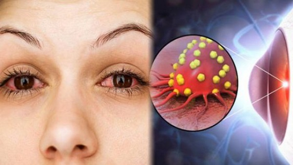 Home Remedies To Prevent Eye Flu In Tamil 